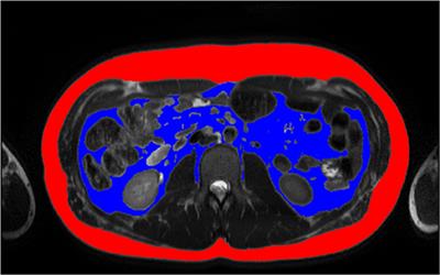 MRI-Derived Subcutaneous and Visceral Adipose Tissue Reference Values for Children Aged 6 to Under 18 Years